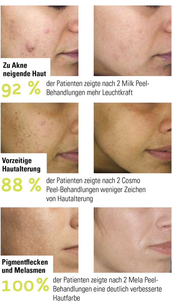 Chemisches Peeling Dr Pavicic Hautarzt München